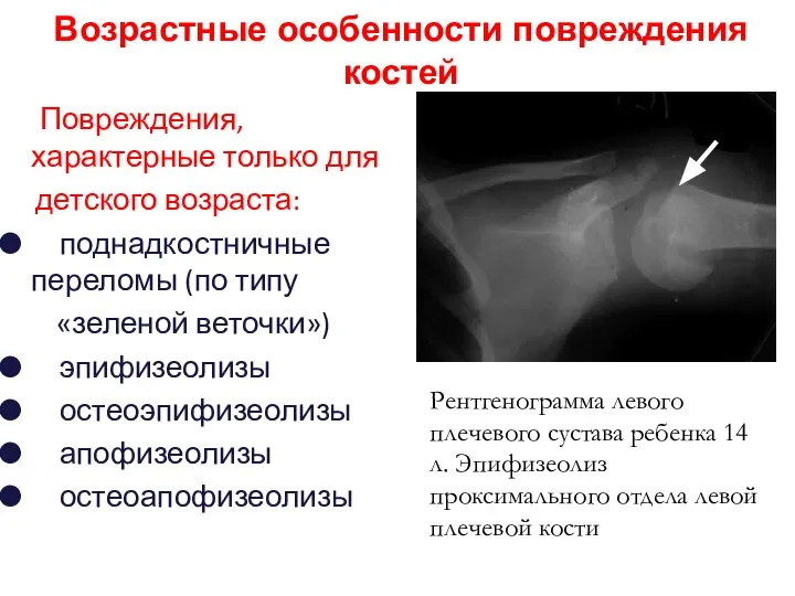 Повреждения, характерные только для детского возраста: поднадкостничные переломы (по типу «зеленой