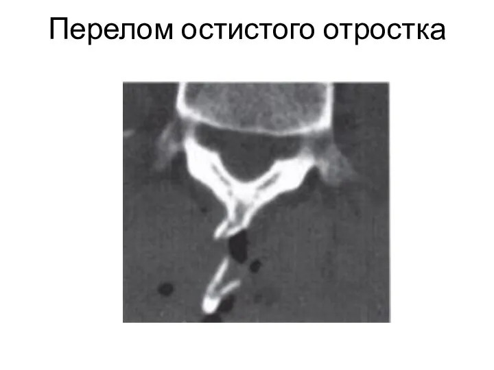 Перелом остистого отростка