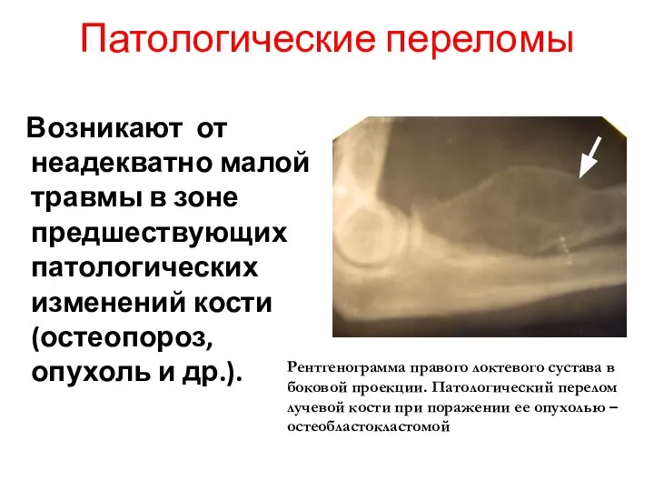 Возникают от неадекватно малой травмы в зоне предшествующих патологических изменений кости