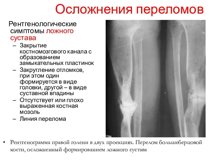 Осложнения переломов Рентгенологические симптомы ложного сустава Закрытие костномозгового канала с образованием