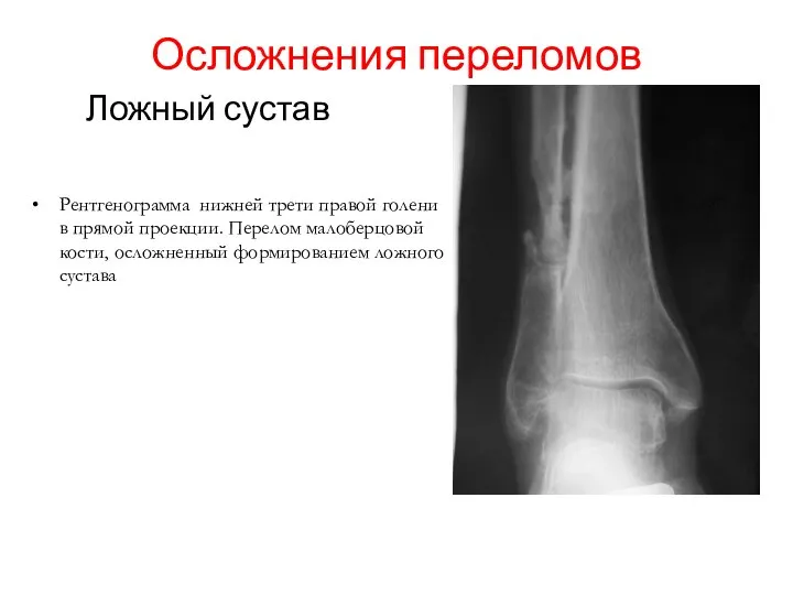 Ложный сустав Осложнения переломов Рентгенограмма нижней трети правой голени в прямой