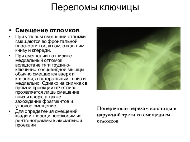 Переломы ключицы Смещение отломков При угловом смещении отломки смещаются во фронтальной