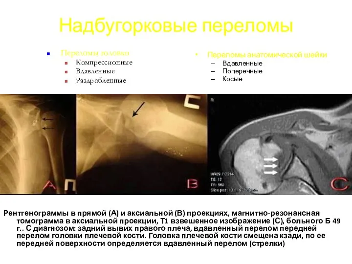 Надбугорковые переломы Рентгенограммы в прямой (А) и аксиальной (В) проекциях, магнитно-резонансная