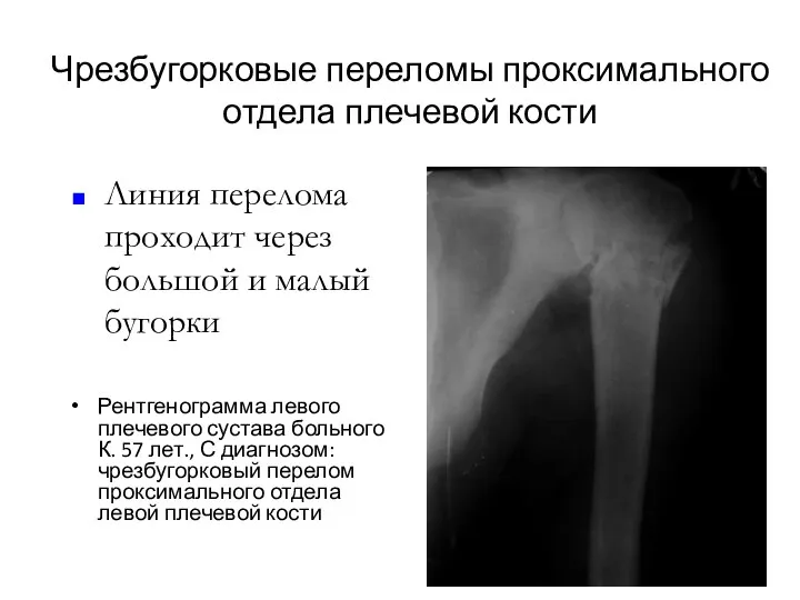 Чрезбугорковые переломы проксимального отдела плечевой кости Рентгенограмма левого плечевого сустава больного