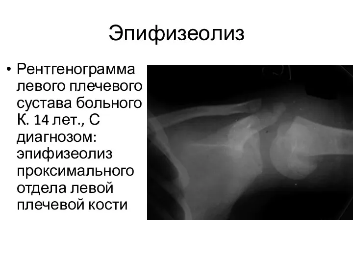 Эпифизеолиз Рентгенограмма левого плечевого сустава больного К. 14 лет., С диагнозом: