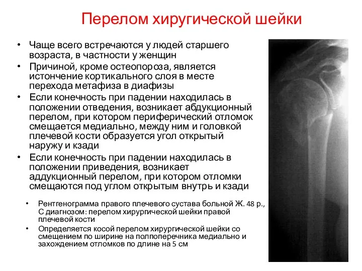 Перелом хиругической шейки Рентгенограмма правого плечевого сустава больной Ж. 48 р.,