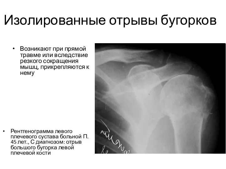 Изолированные отрывы бугорков Рентгенограмма левого плечевого сустава больной П. 45 лет.,