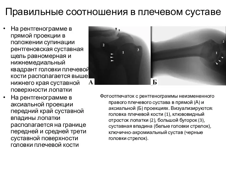 Правильные соотношения в плечевом суставе На рентгенограмме в прямой проекции в