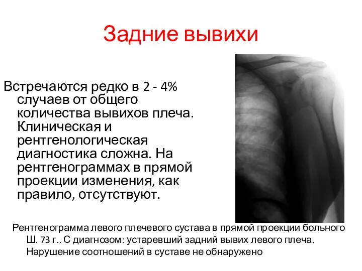 Задние вывихи Рентгенограмма левого плечевого сустава в прямой проекции больного Ш.