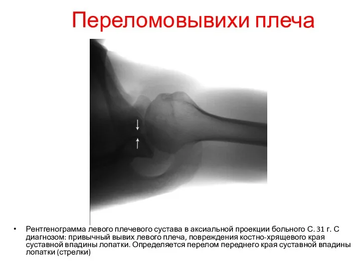 Переломовывихи плеча Рентгенограмма левого плечевого сустава в аксиальной проекции больного С.