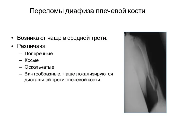 Переломы диафиза плечевой кости Возникают чаще в средней трети. Различают Поперечные