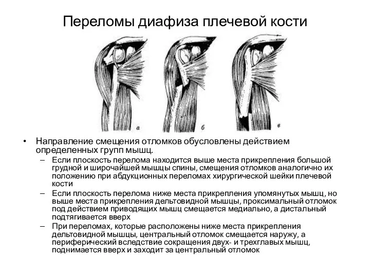 Переломы диафиза плечевой кости Направление смещения отломков обусловлены действием определенных групп