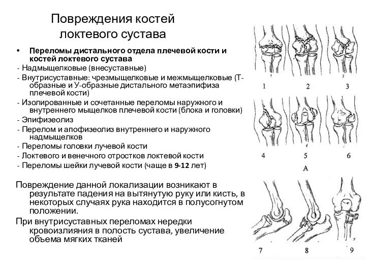 Повреждения костей локтевого сустава Переломы дистального отдела плечевой кости и костей