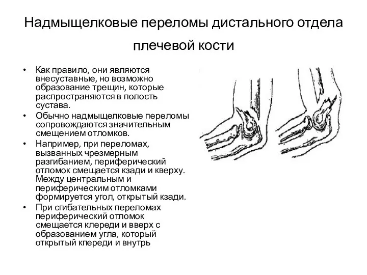 Надмыщелковые переломы дистального отдела плечевой кости Как правило, они являются внесуставные,