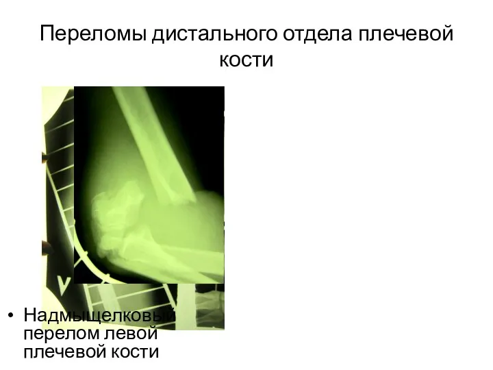 Переломы дистального отдела плечевой кости Надмыщелковый перелом левой плечевой кости