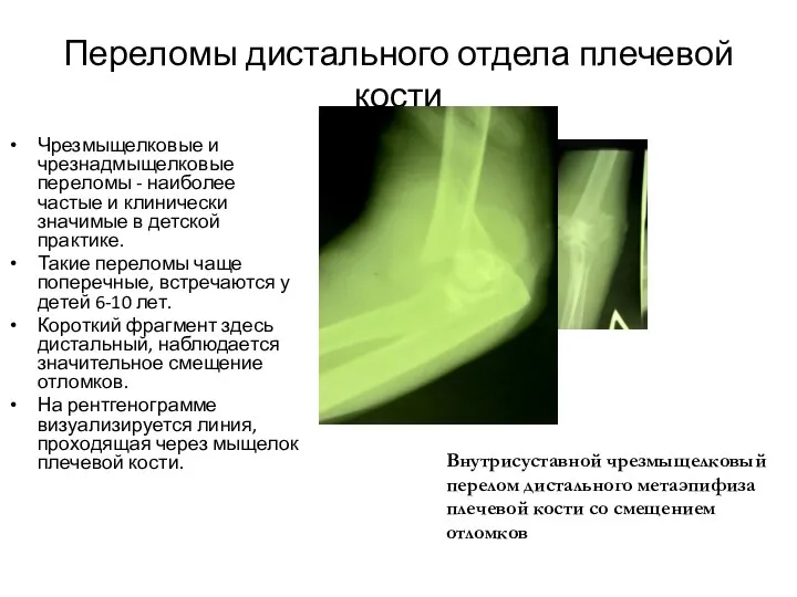 Переломы дистального отдела плечевой кости Чрезмыщелковые и чрезнадмыщелковые переломы - наиболее