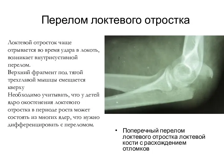Перелом локтевого отростка Поперечный перелом локтевого отростка локтевой кости с расхождением