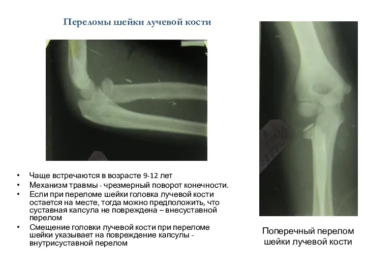 Поперечный перелом шейки лучевой кости Чаще встречаются в возрасте 9-12 лет