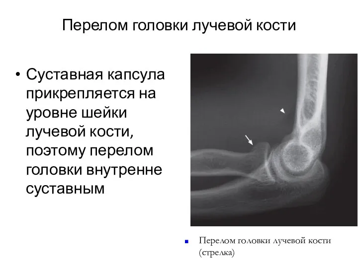 Перелом головки лучевой кости Суставная капсула прикрепляется на уровне шейки лучевой