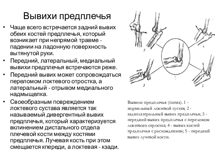 Вывихи предплечья Чаще всего встречается задний вывих обеих костей предплечья, который