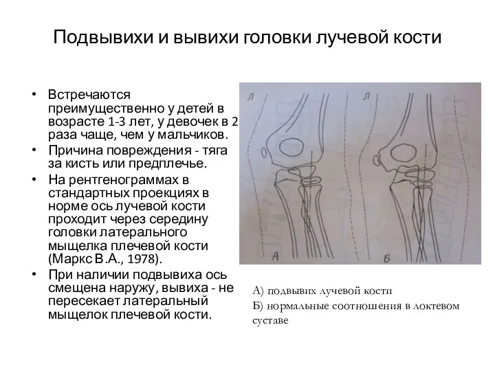 Подвывихи и вывихи головки лучевой кости Встречаются преимущественно у детей в