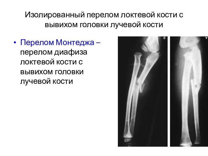 Изолированный перелом локтевой кости с вывихом головки лучевой кости Перелом Монтеджа