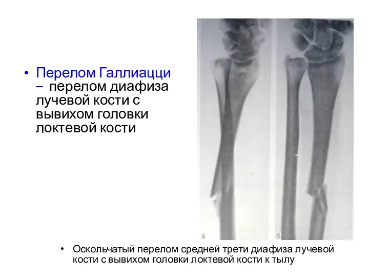 Перелом Галлиацци – перелом диафиза лучевой кости с вывихом головки локтевой