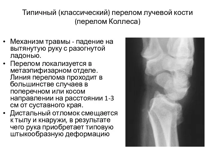 Типичный (классический) перелом лучевой кости (перелом Коллеса) Механизм травмы - падение