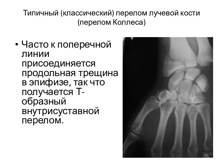 Типичный (классический) перелом лучевой кости (перелом Коллеса) Часто к поперечной линии