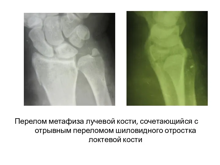 Перелом метафиза лучевой кости, сочетающийся с отрывным переломом шиловидного отростка локтевой кости