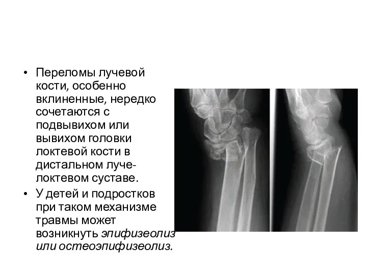 Переломы лучевой кости, особенно вклиненные, нередко сочетаются с подвывихом или вывихом