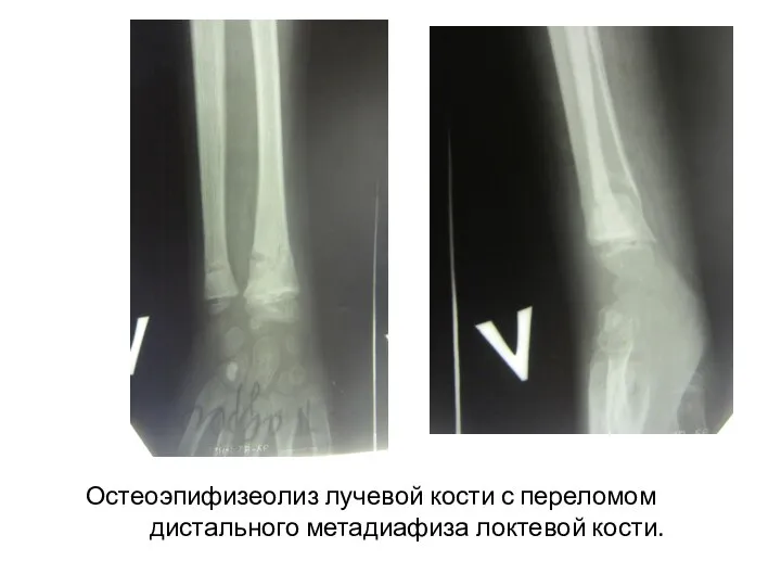 Остеоэпифизеолиз лучевой кости с переломом дистального метадиафиза локтевой кости.