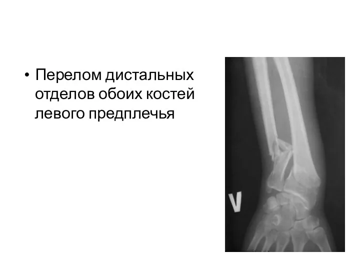 Перелом дистальных отделов обоих костей левого предплечья
