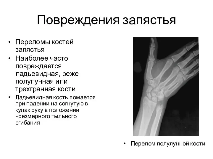 Повреждения запястья Переломы костей запястья Наиболее часто повреждается ладьевидная, реже полулунная