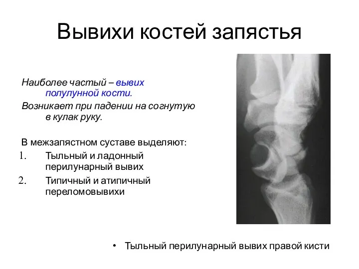 Вывихи костей запястья Наиболее частый – вывих полулунной кости. Возникает при