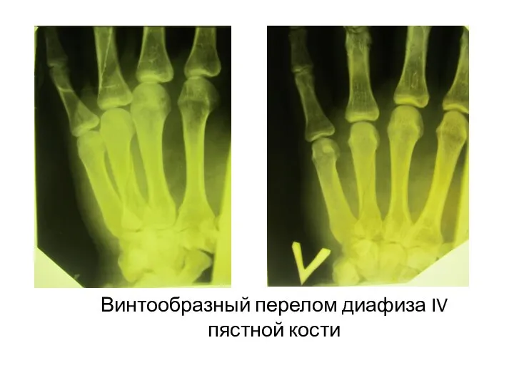 Винтообразный перелом диафиза IV пястной кости