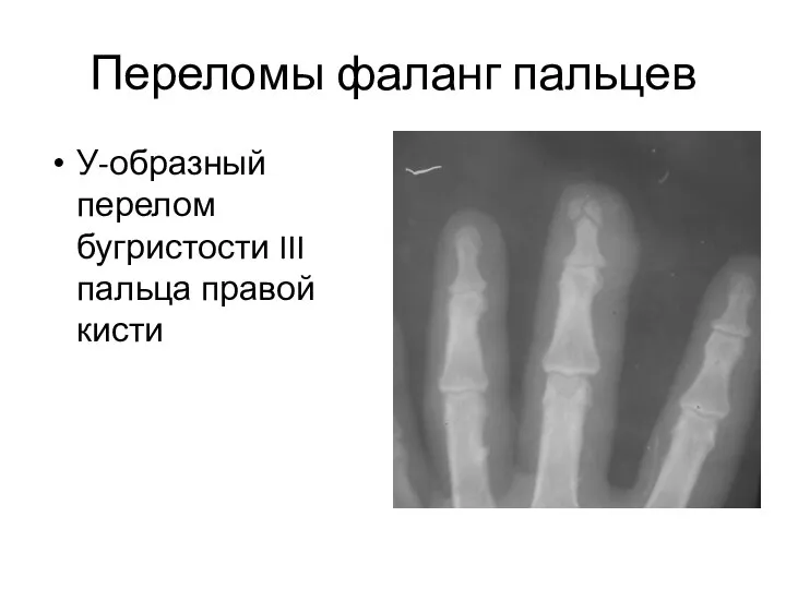 Переломы фаланг пальцев У-образный перелом бугристости III пальца правой кисти