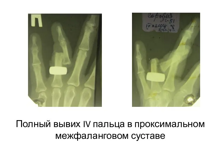 Полный вывих IV пальца в проксимальном межфаланговом суставе