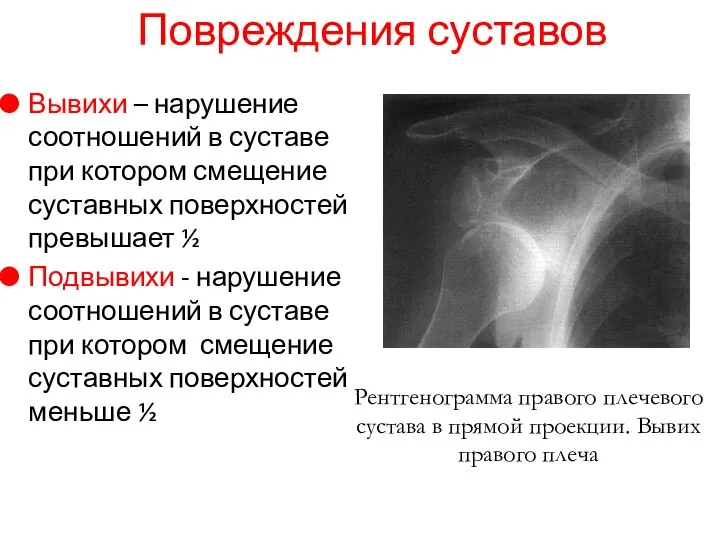 Вывихи – нарушение соотношений в суставе при котором смещение суставных поверхностей