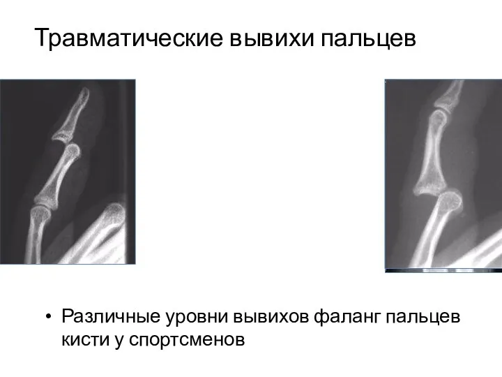 Травматические вывихи пальцев Различные уровни вывихов фаланг пальцев кисти у спортсменов