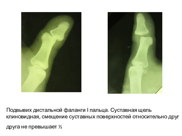 Подвывих дистальной фаланги І пальца. Суставная щель клиновидная, смещение суставных поверхностей