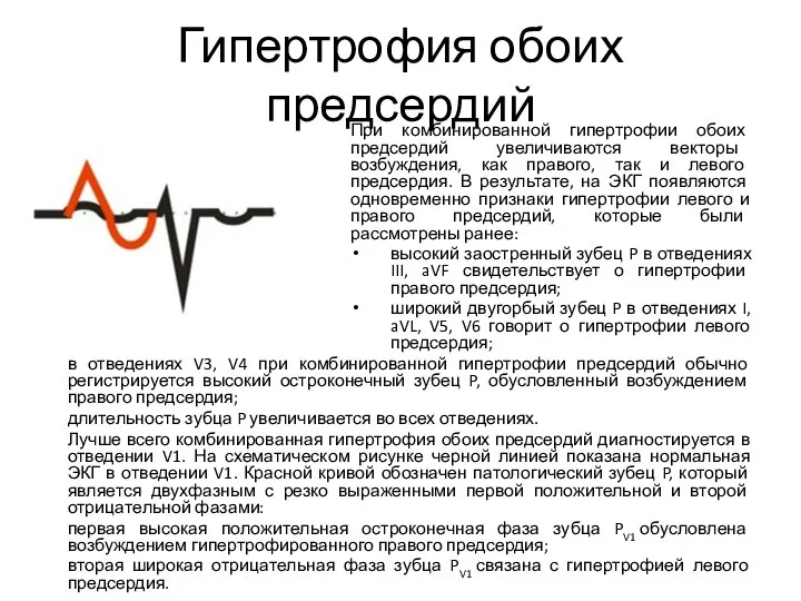 Гипертрофия обоих предсердий При комбинированной гипертрофии обоих предсердий увеличиваются векторы возбуждения,