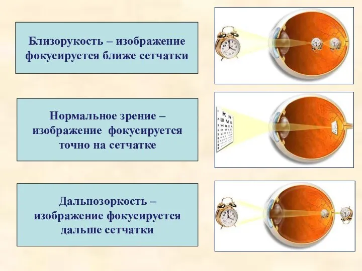 Близорукость – изображение фокусируется ближе сетчатки Нормальное зрение – изображение фокусируется