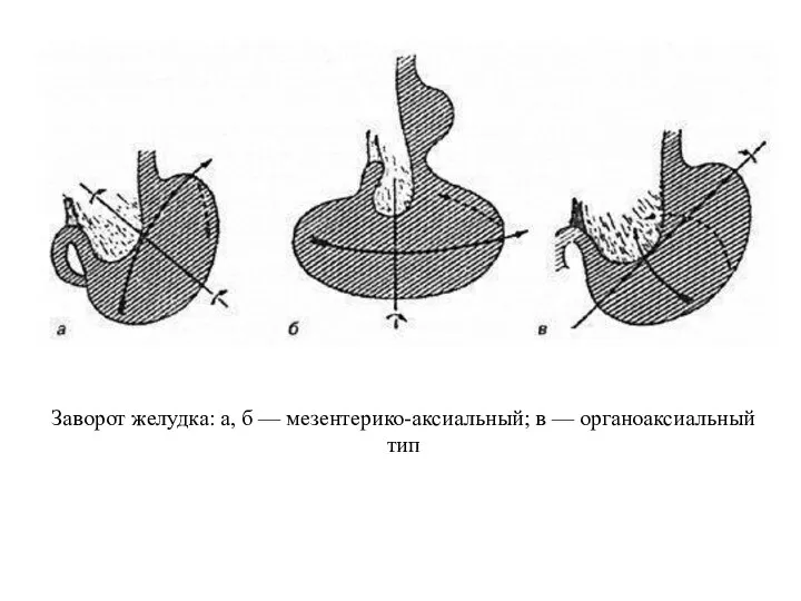 Заворот желудка: а, б — мезентерико-аксиальный; в — органоаксиальный тип