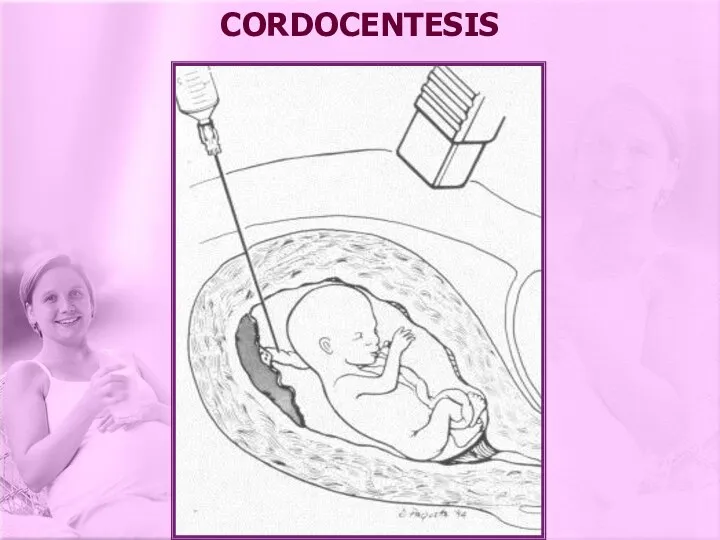 CORDOCENTESIS