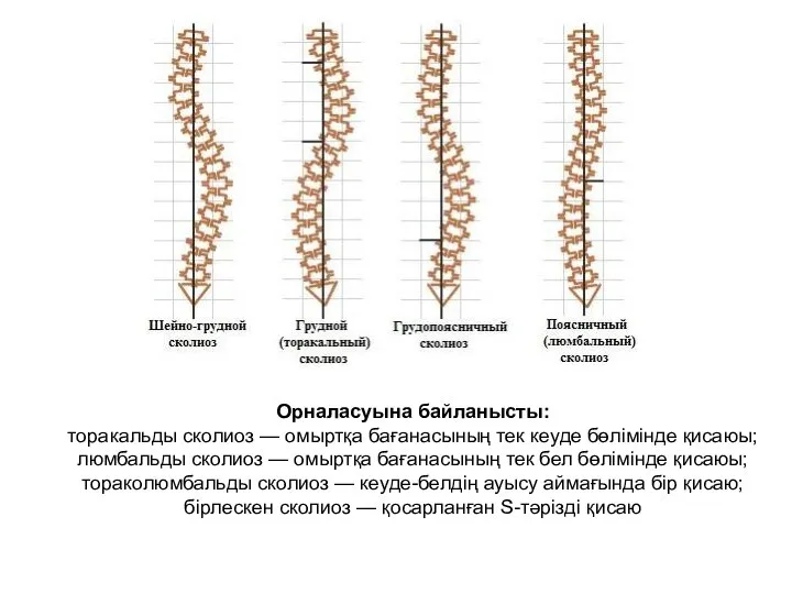 Орналасуына байланысты: торакальды сколиоз — омыртқа бағанасының тек кеуде бөлімінде қисаюы;