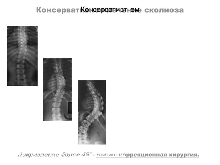 Консервативті ем 45° артық қисаю- тек түзету хирургиясы. 15° дейін қисаю