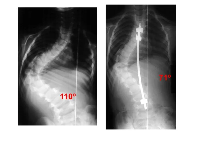 110o 71o Сколиотикалық доғаны түзету және оны одан әрі өрлеуден сақтаутек металл конструкциялар көмегімен мүмкін болады.