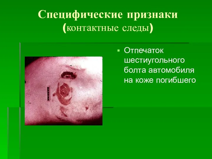 Специфические признаки (контактные следы) Отпечаток шестиугольного болта автомобиля на коже погибшего