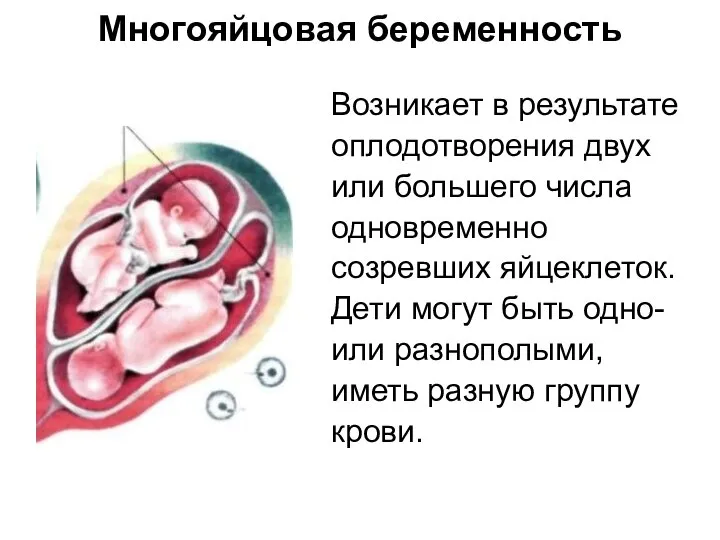 Многояйцовая беременность Возникает в результате оплодотворения двух или большего числа одновременно